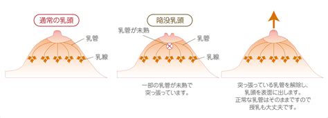 陥没乳頭エロ|陥没乳首画像！！乳房に埋没している乳頭の150枚 